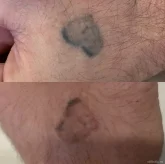 Студия удаления татуировок и татуажа Khusenov_nettattoo фото 3