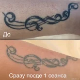 Студия удаления татуировок и татуажа Khusenov_nettattoo фото 2