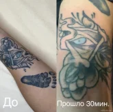 Студия удаления татуировок и татуажа Khusenov_nettattoo фото 4